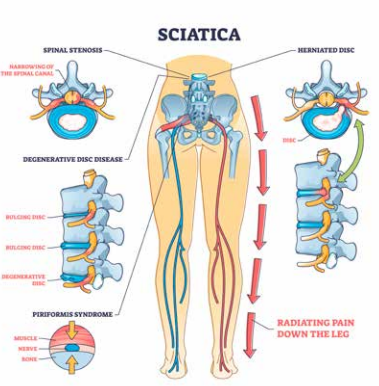 Sciatica