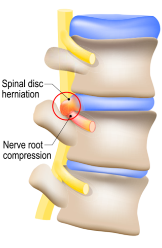 Chiropractor | Penrith |Pinch in your back